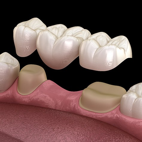 A technician making a dental bridge