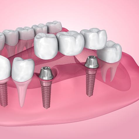 A 3D illustration of a traditional dental bridge