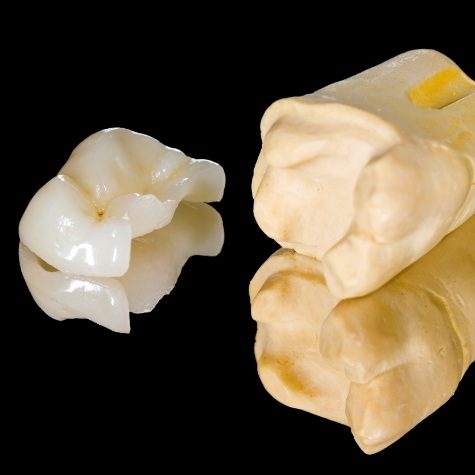 Model tooth with metal free dental crown