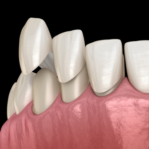 Animated smile during porcelain veneers cosmetic dentistry treatment