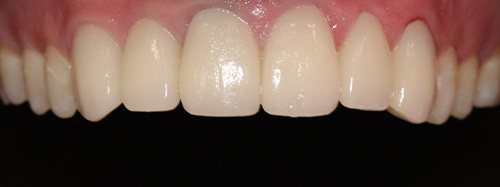 after image for veneers