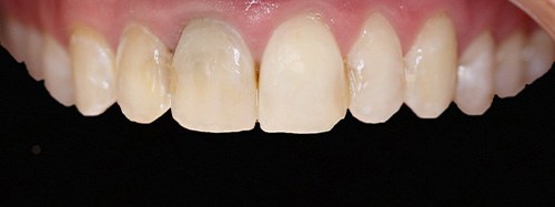 before image for veneers