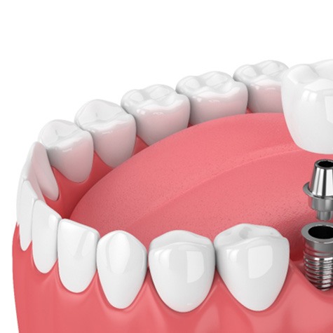 3D graphic of dental implant