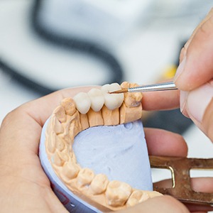 dentist polishing dental bridge 