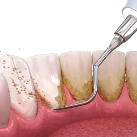 Animated smile during scaling and root planing periodontal disease treatment