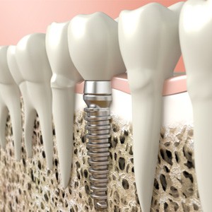 Dental implant in the jawbone