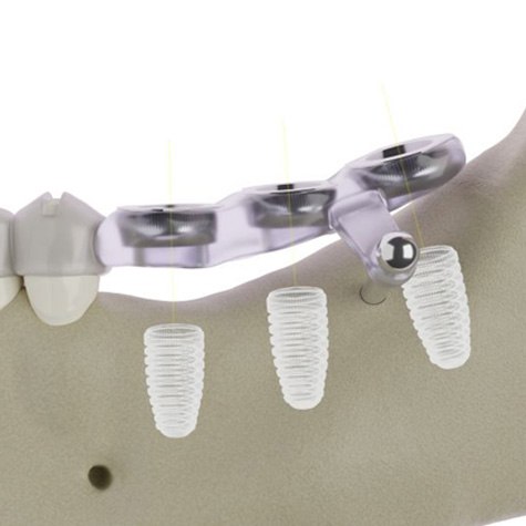 Side-view illustration of dental implant surgical guide