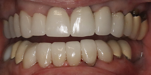 after image for veneers