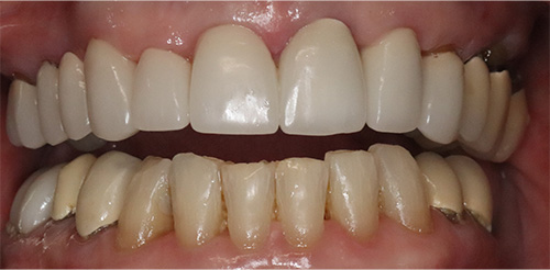 before image for veneers