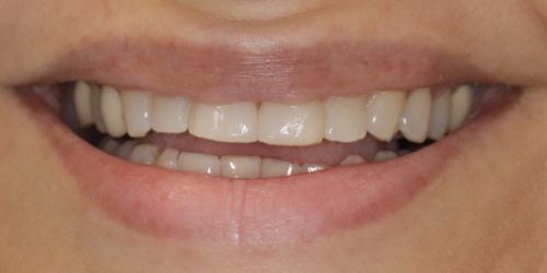 after image for veneers