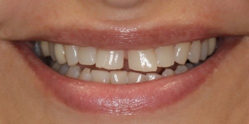 before image for veneers