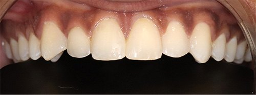 after image for veneers