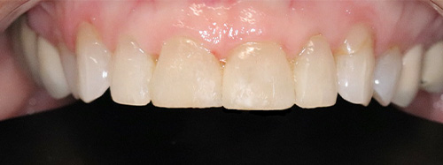 after image for veneers