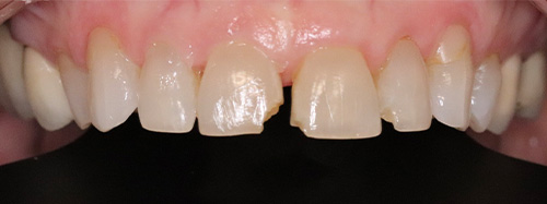 before image for veneers