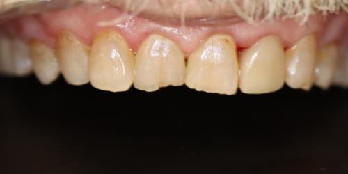 after image for veneers