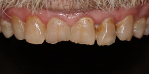 before image for veneers