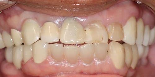 before image for veneers