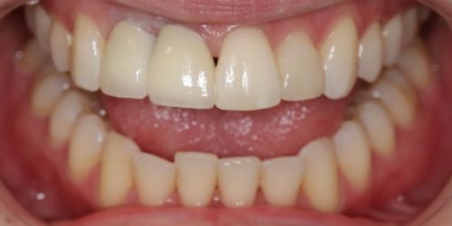 after image for veneers