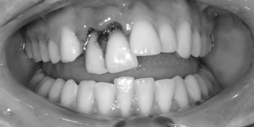 before image for veneers