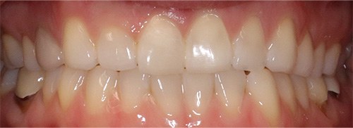 after image for veneers