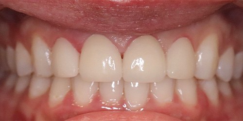 after image for veneers