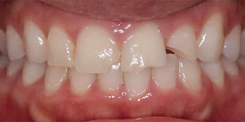 before image for veneers