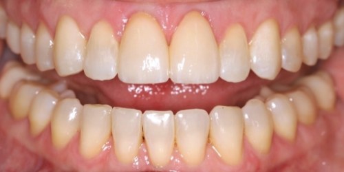 after image for veneers