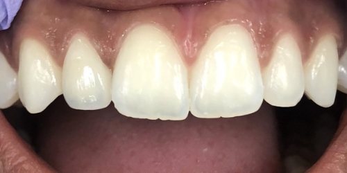 after image for veneers