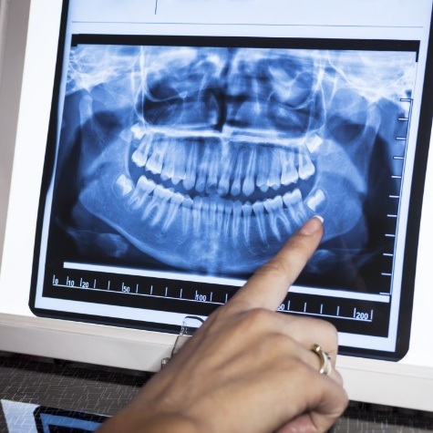 Digital dental x-rays on chairside computer monitor