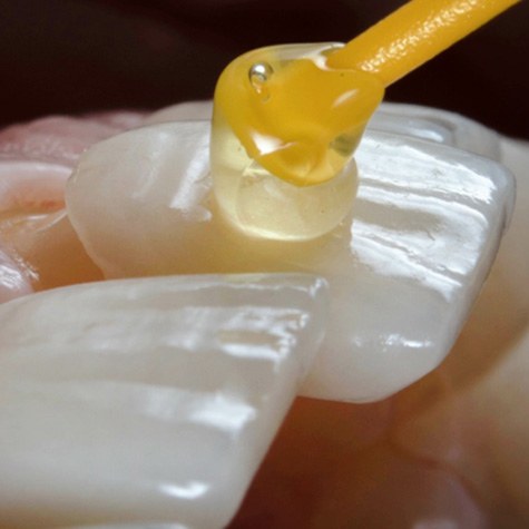 Close up of dentist applying a veneer to a tooth