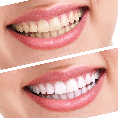 Before and after teeth whitening