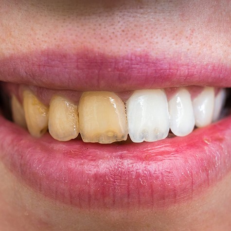 Before and after teeth whitening comparison 