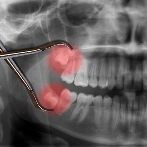 Illustration of an impacted wisdom tooth