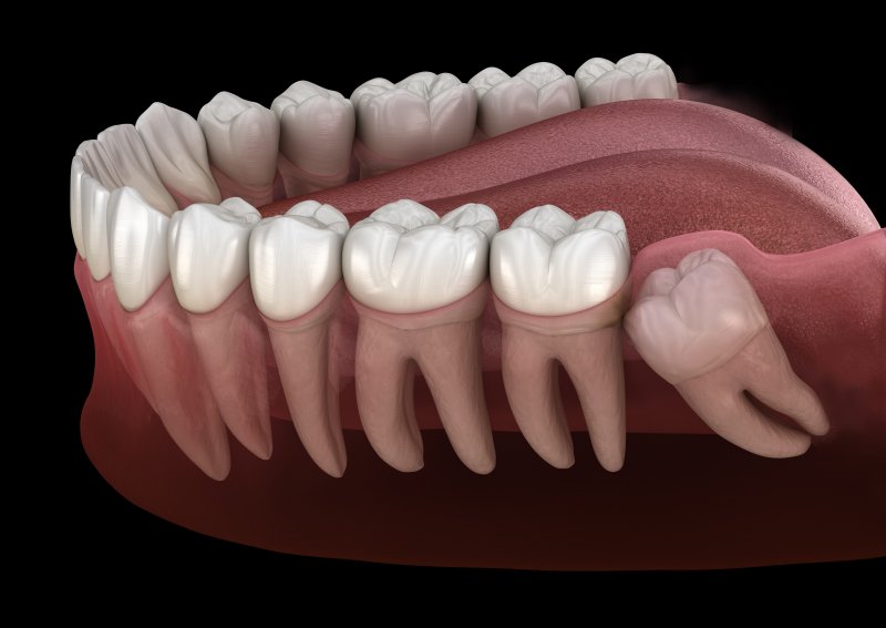 3-D model of a wisdom tooth