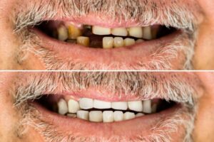 Comparison between missing and complete teeth